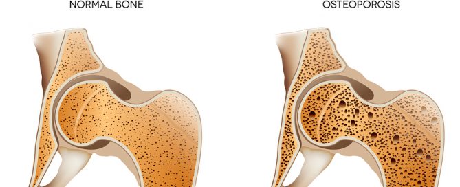 Home Care Services in Phenix City AL: Osteoporosis